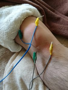 変形性膝関節症、電気鍼