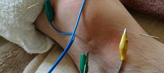 変形性膝関節症、電気鍼